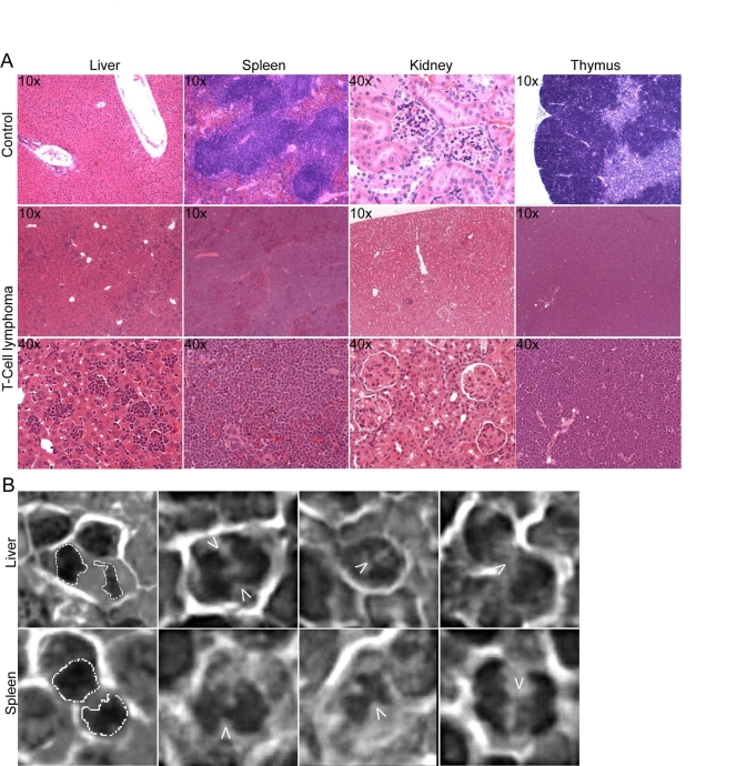 Development of genetically unstable T cell lymphoma in TRF2 overexpressing mice