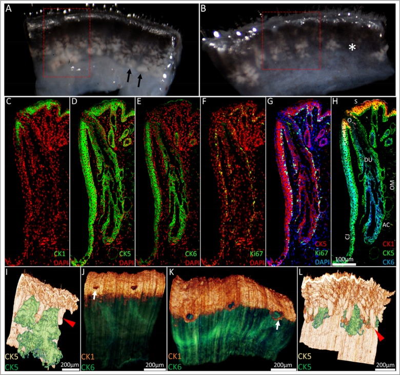 From the macroscopic to the microscopic: ICT reconstruction of the young and aged mouse eyelid. (A) Dissecting microscope images of a 5-month old and (B) 2-year old mouse eyelid. Meibomian glands (black arrowheads) were identified as whitish tissue underneath transparent conjunctiva and gland dropout was observed in the older mouse eyelids (asterisk). Eyelids were embedded in BMMA and serially sectioned; the red box highlights the areas 3-D reconstructed through sequential immunostaining, as shown in C-H (C) A 5month old mouse eyelid 2μm BMMA section stained with CK1 and DAPI before antibody elution with glycine HCl and subsequent immunostaining with (D) CK5, (E) CK6 and (F) Ki67 antibodies. The resulting overlays (G and H) show the meibomian gland parallel to the conjunctiva (CJ) and embedded in the orbicularis muscle (OM). The meibomian gland duct (DU) and orifice (O) are CK5+/CK6+, whereas acinar (AC) and skin (S) epithelium are CK5+/CK6−. CK5-based reconstructions of a (I) 5month and (L) 2year old mouse eyelid visualised the hair follicle (red arrowheads) and meibomian gland epithelia (green), confirming the truncation of meibomian glands with age. In 3-D, CK1 staining at the lid margin of (J) young and (K) old lids revealed a loss of a layer of epidermal cells posterior to meibomian gland orifices in the older lid. This caused an anterior shift of the mucocutaneous junction (white arrows) to the level of the meibomian gland orifices.
