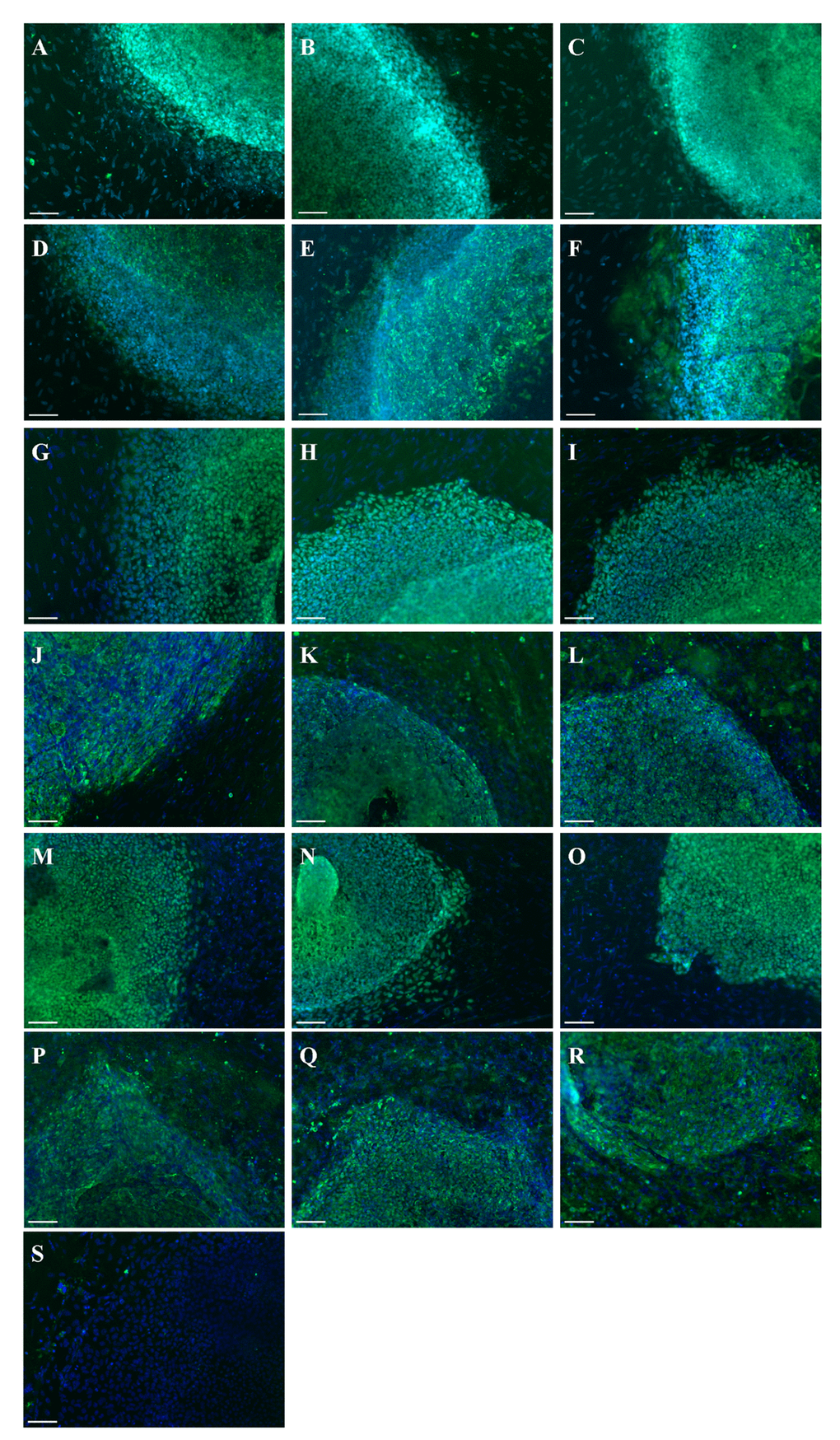 Generation of iPSC lines from FRDA-patients. Immunostaining of FA6 CL1 (A, D), CL2 (B, E), CL3 (C, F) for OCT4 (A-C) and TRA-1-60 (D-F); FA8 CL1 (G, J), CL2 (H, K), CL3 (I, L) for OCT4 (G-I) and TRA-1-60 (J-L); FA9 CL1 (M, P), CL2 (N, Q), CL3 (O, R) for OCT4 (M-O) and TRA-1-60 (P-R). (S) Negative isotype. Cells were counterstained with DAPI (blue). Scale bars: 50 μm.