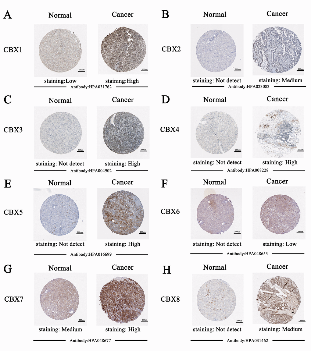 Representative immunohistochemistry images of distinct CBXs family members in HCC tissues and normal liver tissues (Human Protein Atlas). CBX2/5/7/8 proteins were not expressed in normal liver tissues, whereas their low and medium expressions were observed in HCC tissues (B, E, G-H). Low protein expressions of CBX1/3/4 were found in normal liver tissues, while their medium and high protein expressions were observed in HCC tissues (A, C-D). Low protein expression of CBX6 was observed both at normal liver tissues and HCC tissues (F).