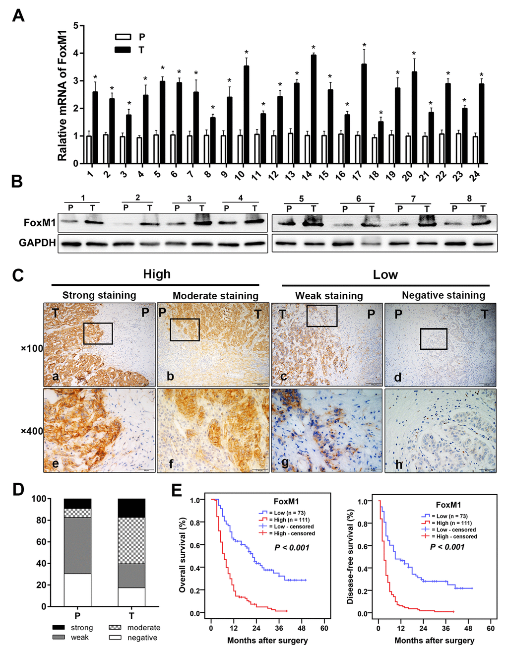 FoxM1 was upregulation in ICC and correlated with survival. The mRNA expression (A) and protein expression (B) of FoxM1 in ICC tumor tissues compared with the expression in paired peritumoral tissues. (C) Representative immunohistochemical staining images of FoxM1 in ICC. (D) The bar graph shows the statistics for the staining intensity of FoxM1 in 184 ICC tumor samples and paired peritumoral tissues. (E) Kaplan-Meier curves for the overall survival and disease-free survival of 184 patients with ICC according to the expression of FoxM1. Abbreviations: ICC, intrahepatic cholangiocarcinoma; P, peritumoral tissue; T, tumor tissue. *P 