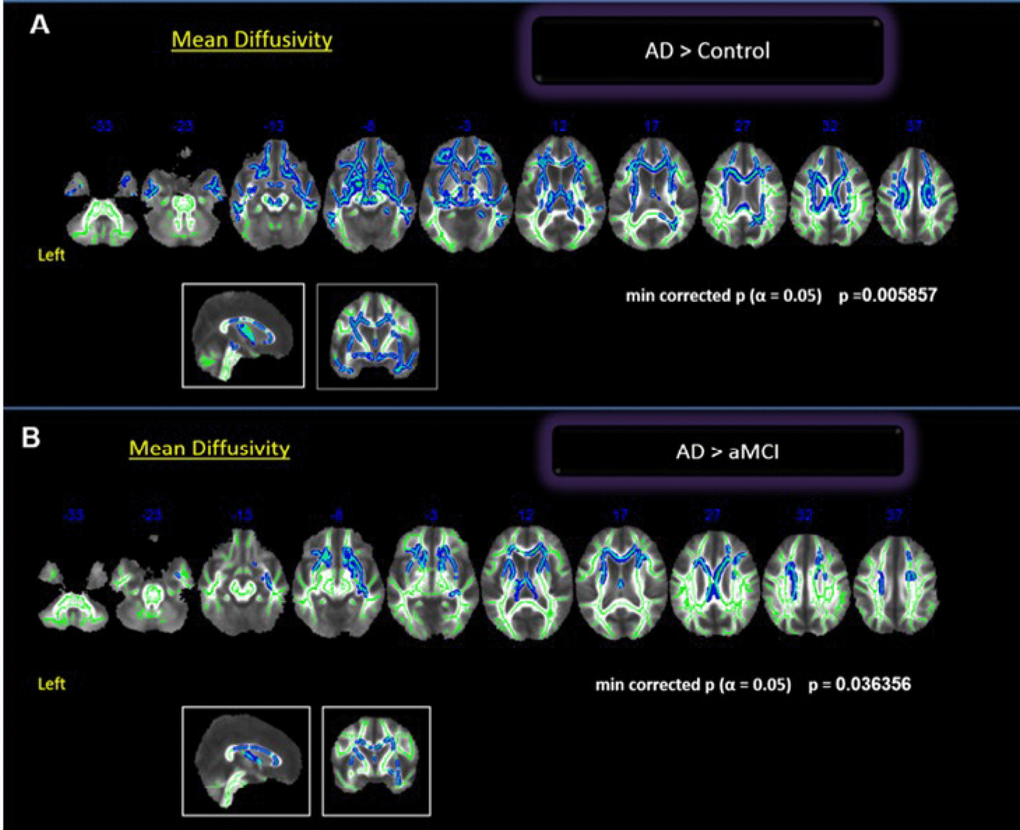 Whole brain comparisons between groups. Cluster of voxels significantly different, corrected for multiple comparisons (p = 0.05) of MD values shown in blue. (A) Comparison between controls and AD; (B) Comparison between aMCI and AD.