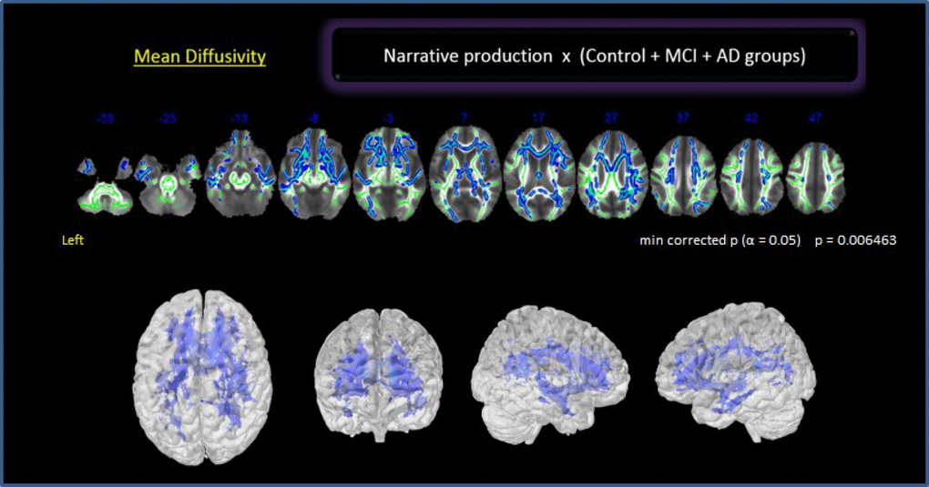 Correlation between NProd and whole brain for all groups. Clusters of voxels significantly different MD shown in blue.