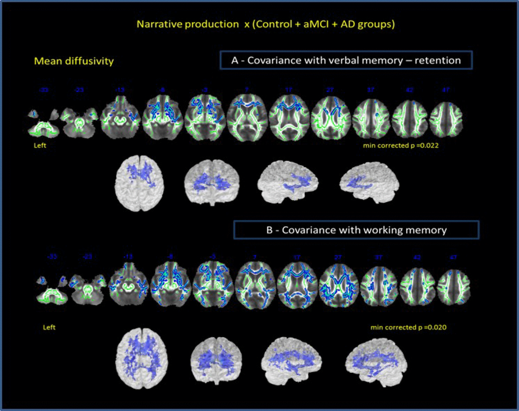 Correlation of all groups performance in narrative discourse and whole-brain analysis. (A) -verbal memory (results of RAVLT test – retention A7-A5) and (B) working memory (results of auditory digit span backward) as covariates. Cluster of voxels significantly different in MD value is shown in blue.