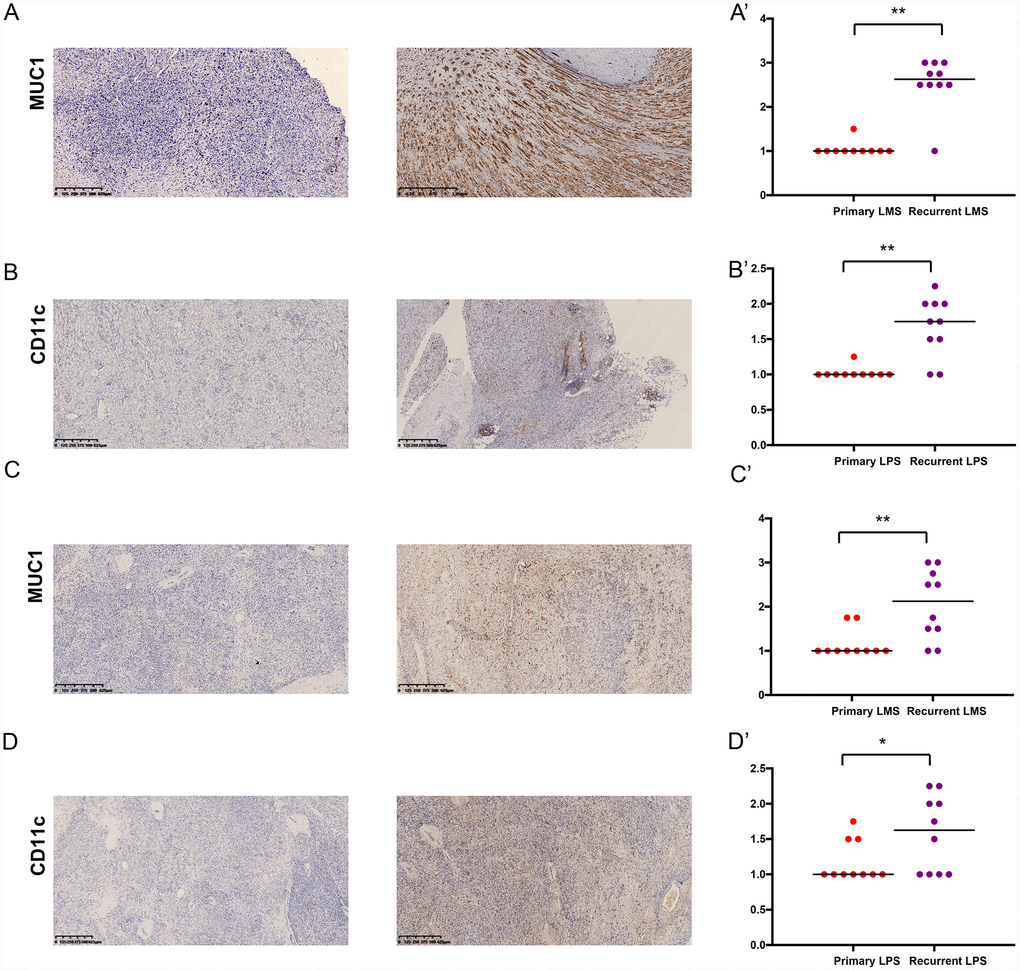 The expressions of MUC1 and CD11c proteins in primary/ recurrent leiomyosarcoma (LMS) (A, B) and liposarcoma (LPS) (C, D) specimens examined by immunohistochemistry (IHC) assay. The upper one is primary STS and under one is recurrent STS.
