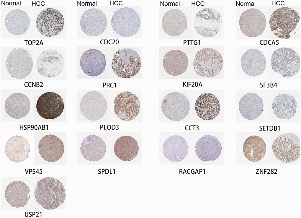 High expression of genes by immunohistochemistry.